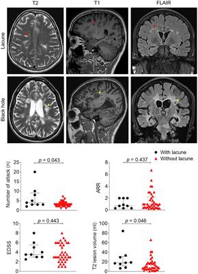 Lacunes are associated with late-stage multiple sclerosis comorbidities